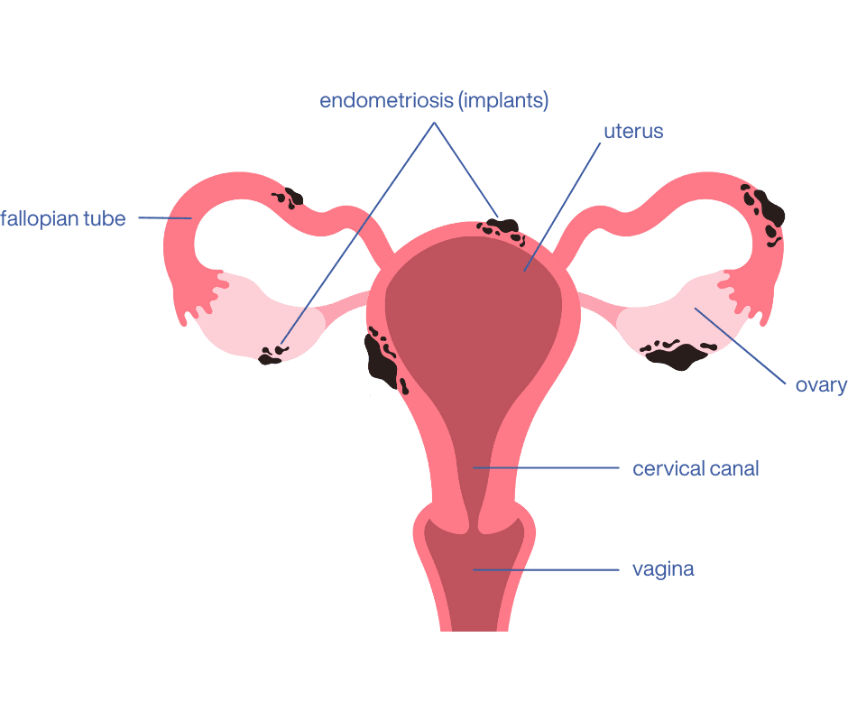 infographic of areas of life impacted by endometriosis